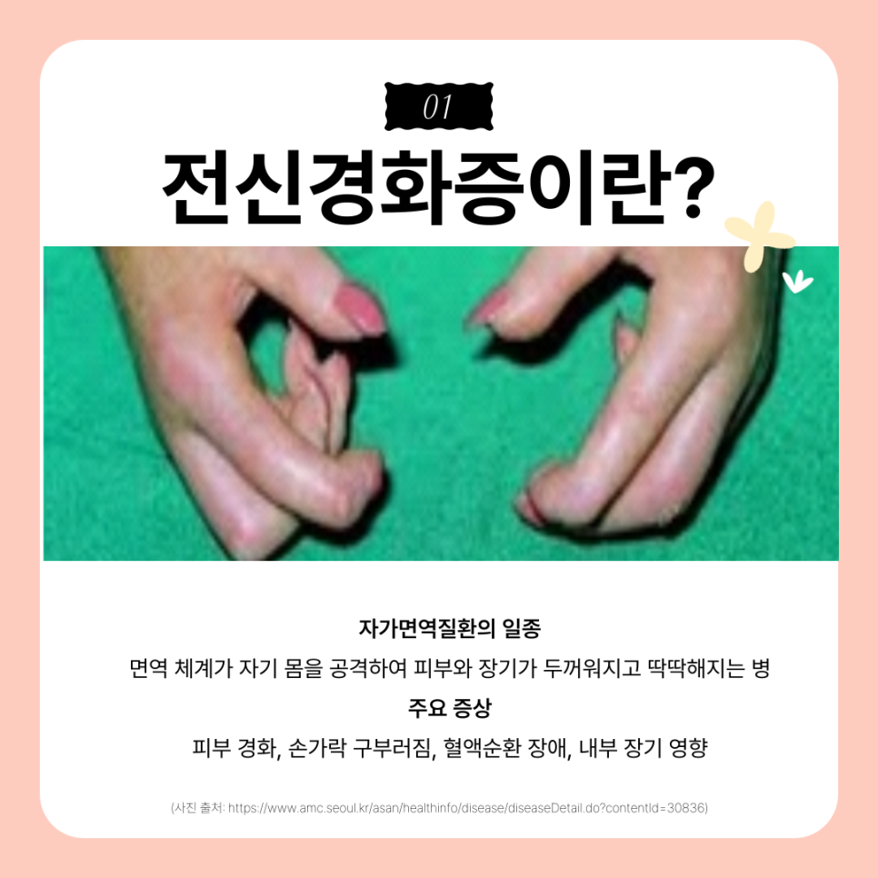 002-1 전신경화증, 희귀병이지만 희망이 있다? 성슐랭 가이드가 소개하는 지방유래 줄기세포 치료의 가능성 | SC301의원