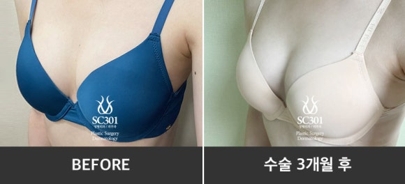 04 왜 가슴성형은 보형물이 아닌 줄기세포 가슴성형일까?
