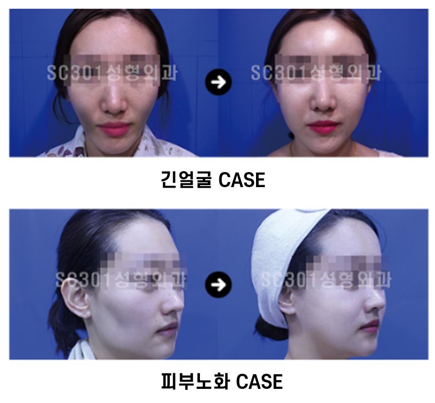 image-3 줄기세포 동안성형, 자연스럽게 어려지는 법