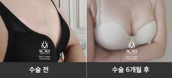 image-7 마른 체형 가슴성형, 줄기세포로