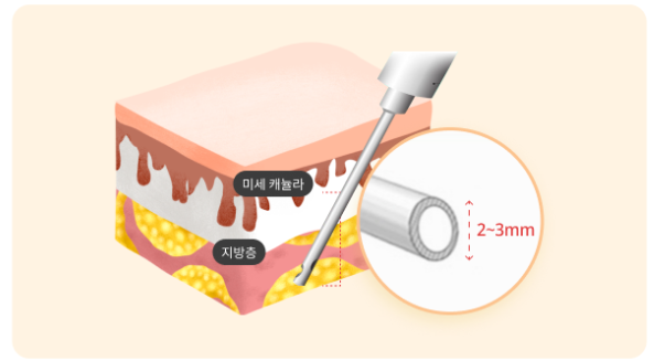 image-16 지방 흡입 병원 선택, 놓치기 쉬운 체크포인트