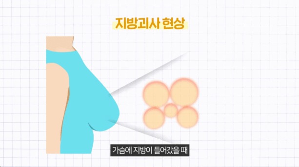 image SVF 가슴성형, 기존 가슴성형과 무엇이 다를까?