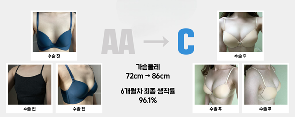 image-12 마른 체형 가슴성형 선택 가이드