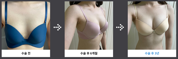 image-14 마른 체형 가슴성형 선택 가이드