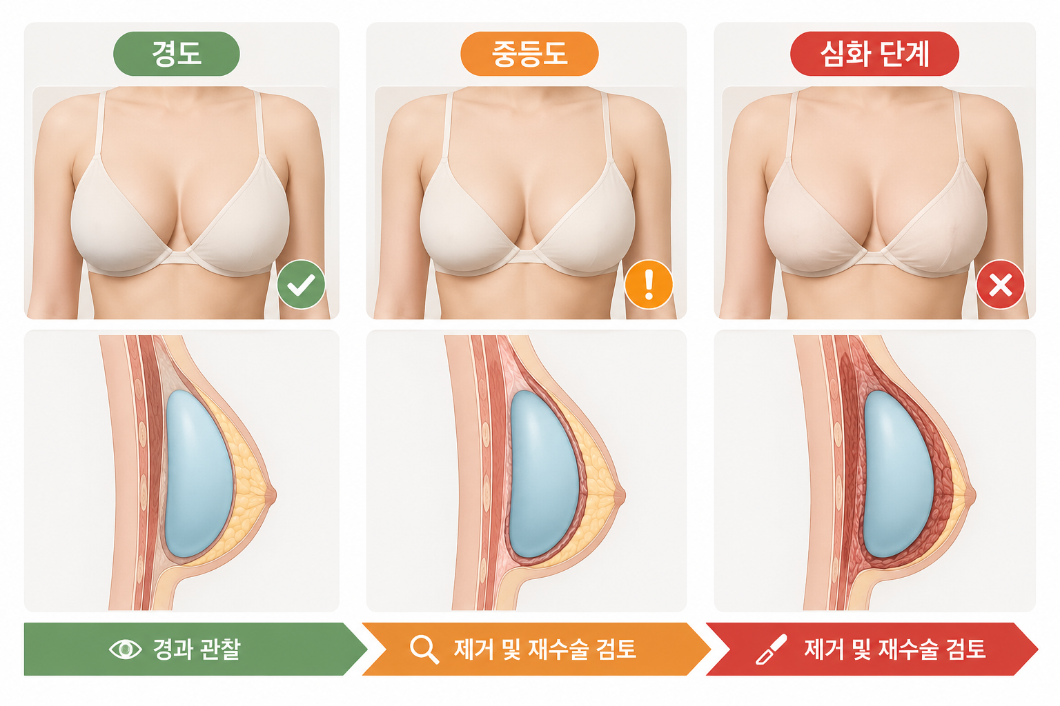 82b3c738-4c63-4ee5-9901-0d31bfc0a280 보형물 제거 후 재수술 — SVF 가슴성형이 대안으로 고려되는 이유
