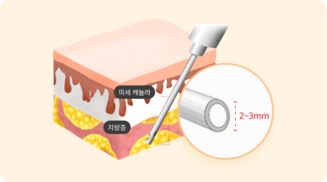 캐뉼라 SVF 가슴성형 회복기간 — 절개 부위부터 일상 복귀 시기까지