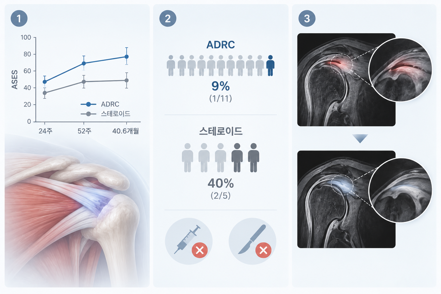 ADRC-어깨-치료-결과 회전근개 부분파열, 스테로이드 대신 지방줄기세포(ADRC) 주사하면 — 3년 추적 결과