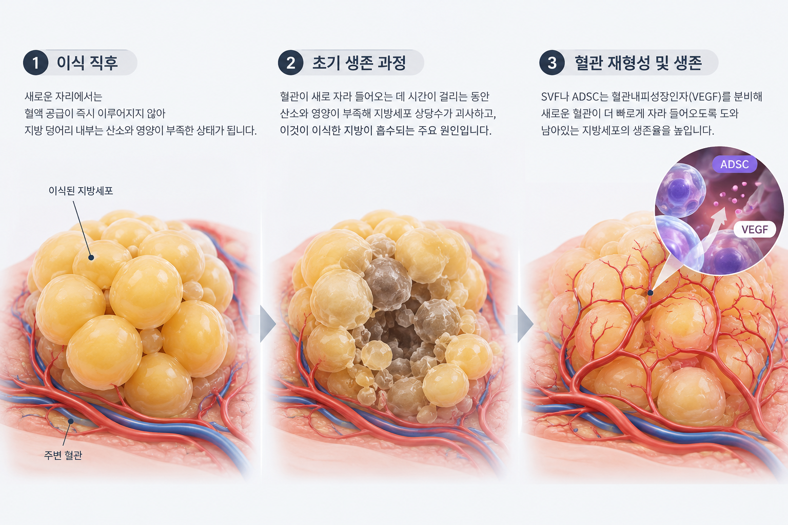 지방이식-생존과-혈관-재형성 지방이식에 줄기세포를 더하는 이유 — 생착의 생물학적 원리