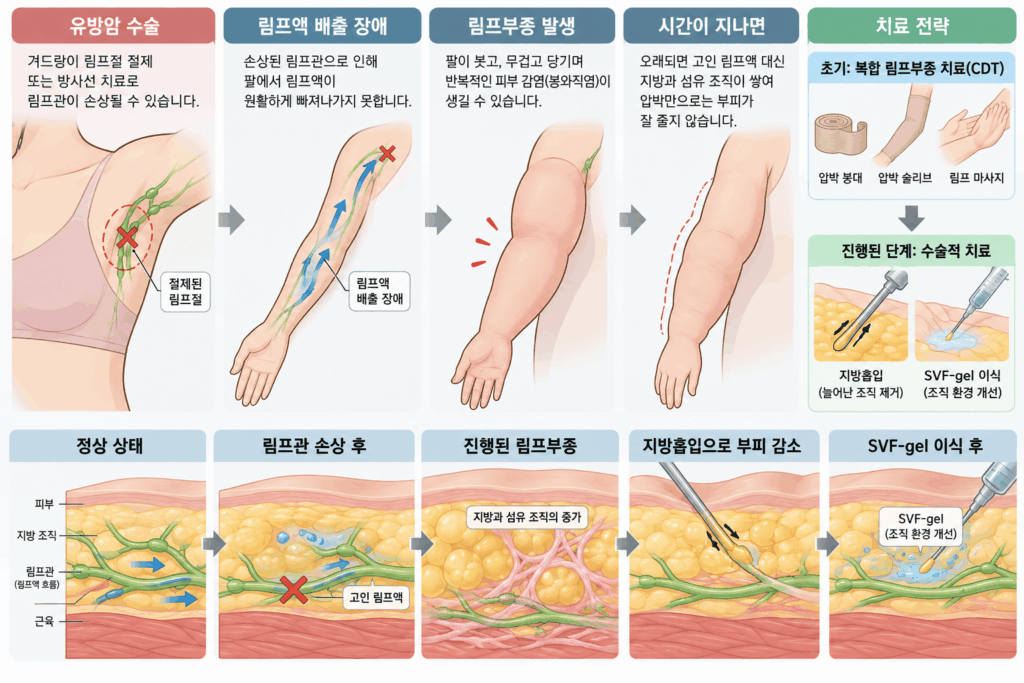 유방암-수술-후-림프부종-치료-1024x683 유방암 수술 후 팔 림프부종, 지방흡입에 SVF-gel을 더하면 — 12명 1년 추적 연구 리뷰