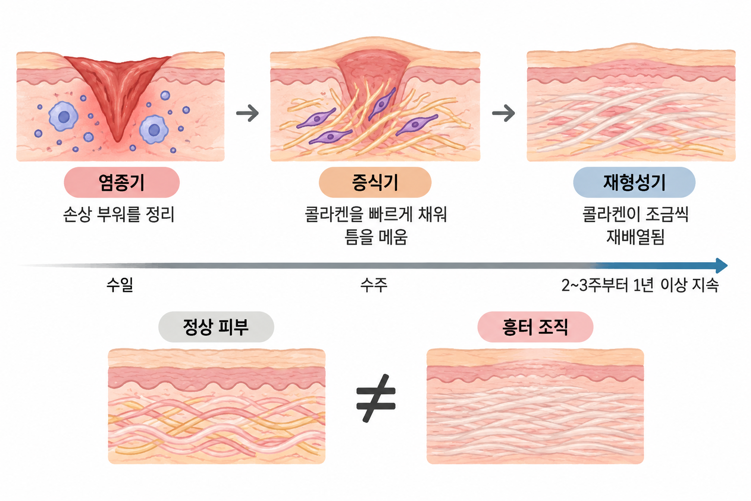 흉터-경과 흉터 재생치료가 여러 회로 나뉘는 이유 — SVF와 흉터 조직의 재형성 시간