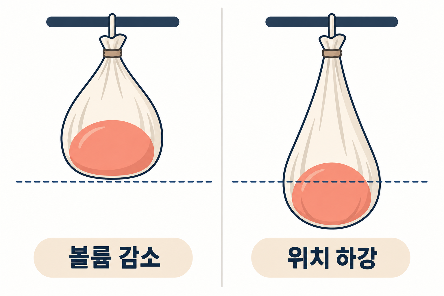 가슴-처짐의-케이스 '처진 가슴, 지방이식만으로 올라갈까? — 처짐 단계별로 보는 가슴거상과 지방이식의 역할'