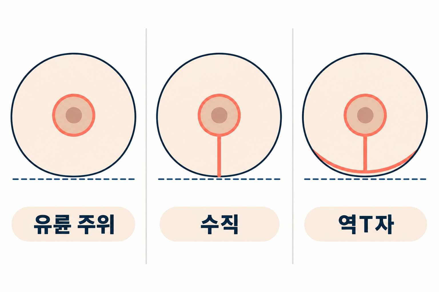 가슴거상-절개-방식 '처진 가슴, 지방이식만으로 올라갈까? — 처짐 단계별로 보는 가슴거상과 지방이식의 역할'
