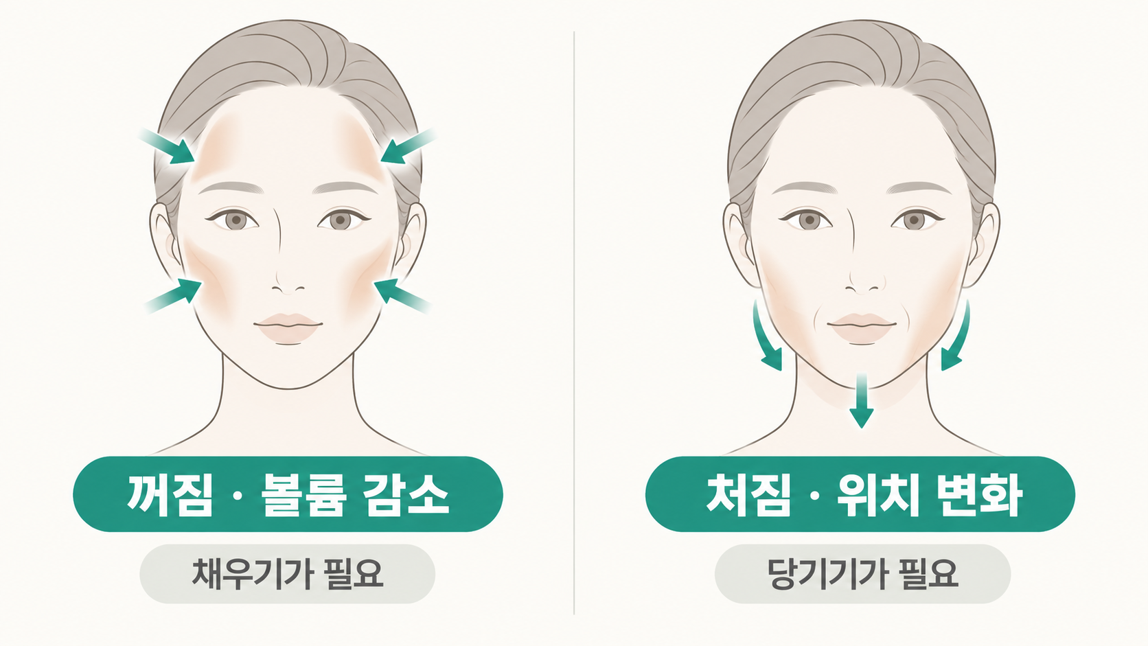 꺼짐과-처짐-비교 셀핏리프팅, 꺼진 곳은 채우고 처진 곳은 당기는 원리 — 볼륨과 리프팅을 함께 설계하는 이유